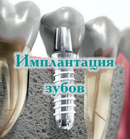 Имплантация Зубов